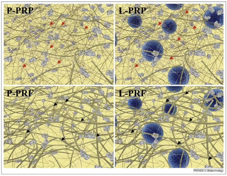 Schematic of P-PRP, L-PRP, P-PRF and L-PRF matrix structures